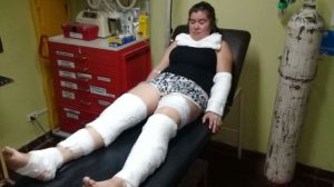 Odisea en Chile: Mendocina sufrió quemaduras tras la explosión de un horno
