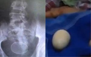 Video: Niño pone huevos como una gallina y es un misterio para los médicos