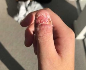 Se mordió tanto las uñas que le dio cáncer y le tuvieron que amputar el dedo