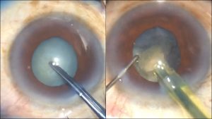 El impactante video viral que muestra como se remueve una catarata del ojo