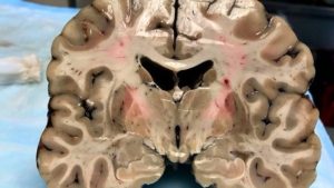 Científicos se sorprendieron al analizar el cerebro de un asesino