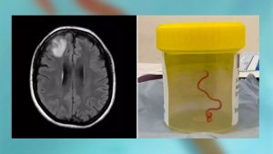 "Estaba vivo y retorciéndose": le sacaron un gusano del cerebro a una mujer